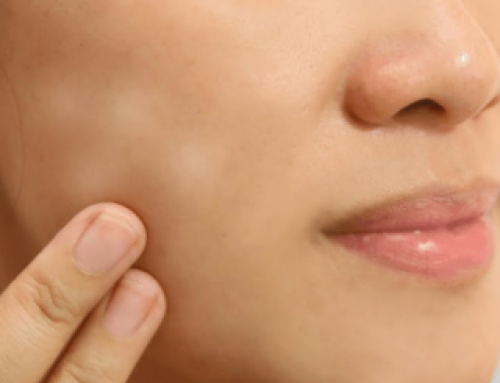How to Get Rid Of White Spots On Face